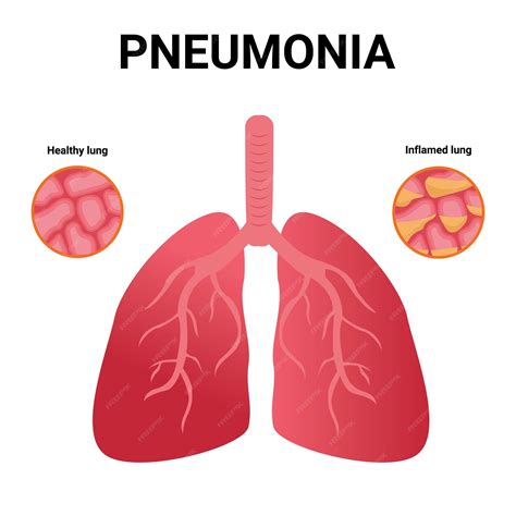 Neumonía alvéolos normales e infectados icono plano de dibujos animados de pulmones sanos y ...