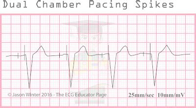 Image result for Pacemaker Programming