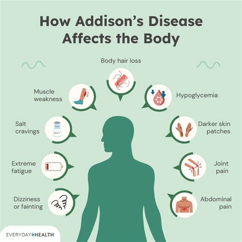 What Is Addison’s Disease? Symptoms, Causes, Diagnosis, Treatment, and Prevention