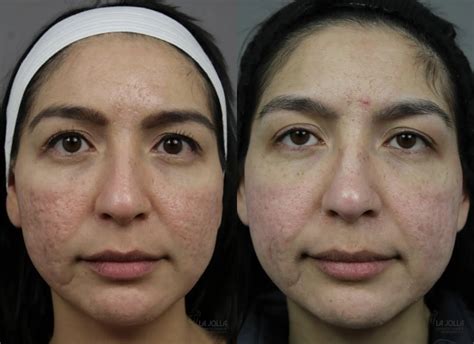 Fraxel Acne Scars Before And After Laser Treatment Acne Scars NYC