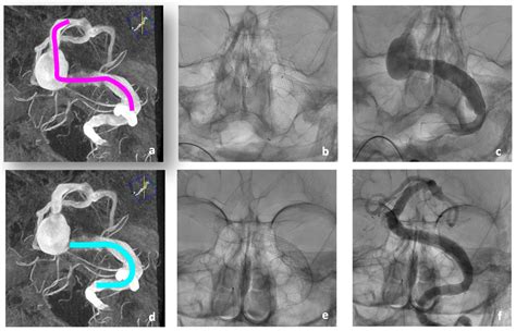 A Giant Stent for Giant Cerebral Aneurysms—The Accero®-Rex-Stent