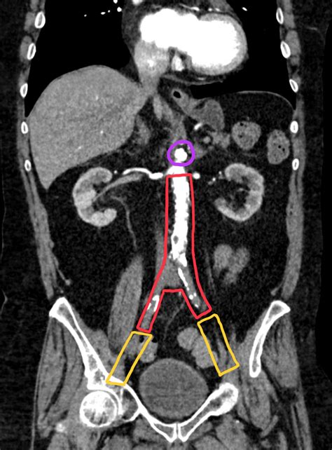 Aortoiliac Occlusive Disease. CT Coronal 1. Annotated. JETem 2022 - JETem