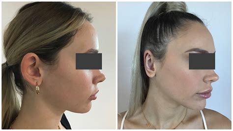 Image result for Ear Modification