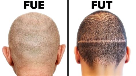 Traditional and Modern Hair Transplant In Malaysia (FUE and FUT ...
