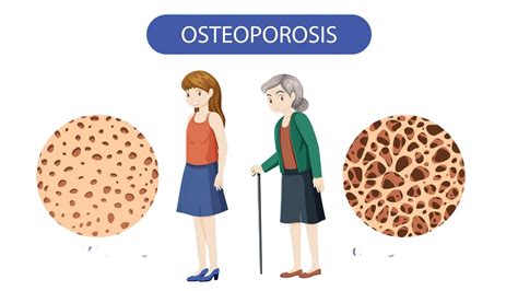 Why Osteoporosis is More Common in Women
