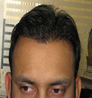 Before and After Photos - Case B010