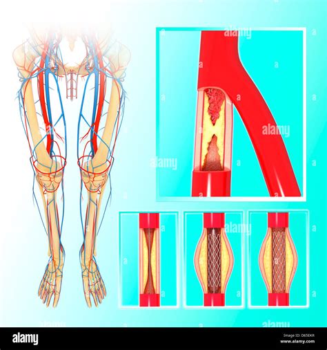 Lower leg arteries hi-res stock photography and images - Alamy