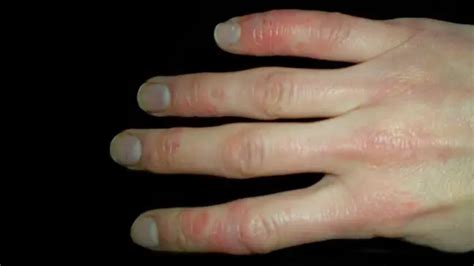 Image result for Diffuse Systemic Scleroderma