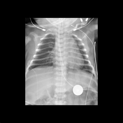 Pediatric Esophageal Temperature Probe Malfunction | Pediatric Radiology Reference Article ...