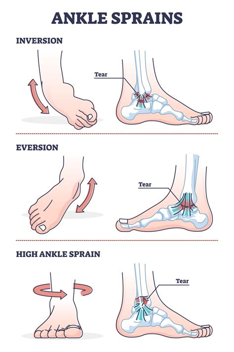 Chronic ankle sprain and instability injections and treatments