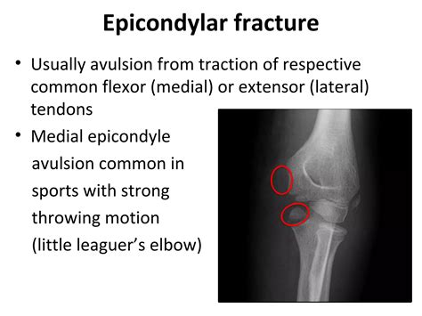 Radiology of the Elbow Joint. Dr. Sumit Sharma | PPT