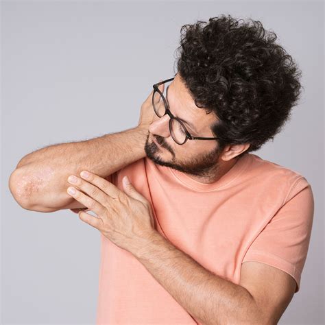 Causes Eczema Flare Ups Babies at Harrison Greenwood blog