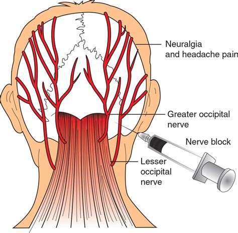 Lesser Occipital Nerve Distribution