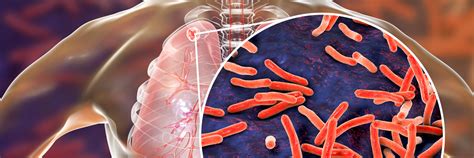 World tuberculosis day 2025: Raising awareness to support global TB ...