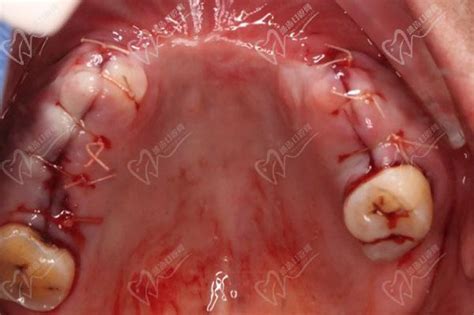 种植牙失败的处理方案都在这里，有没有你想要的 - 知乎