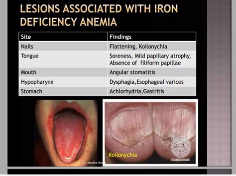 Approach to microcytic hypochromic anemia | PPTX