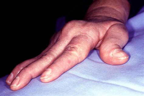 Swan Neck Deformity: Symptoms, Causes and Treatment