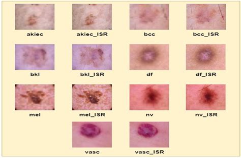 Image result for How Skin Cancer Forms