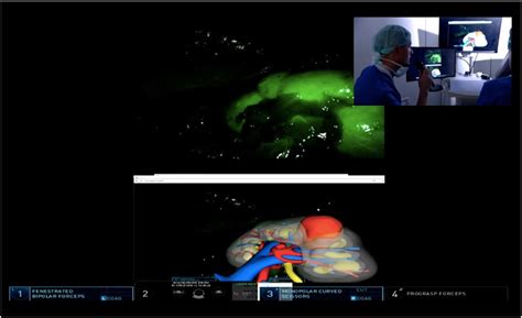 Image result for Robot-Assisted Partial Nephrectomy