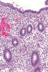 Image result for Disordered Proliferative Endometrium