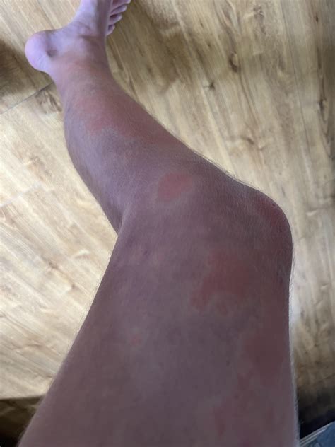 Legs Turned Red at Robert Locklear blog