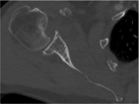 Arthroscopic retrograde disimpaction of reverse Hill-Sachs lesions in acute posterior shoulder ...