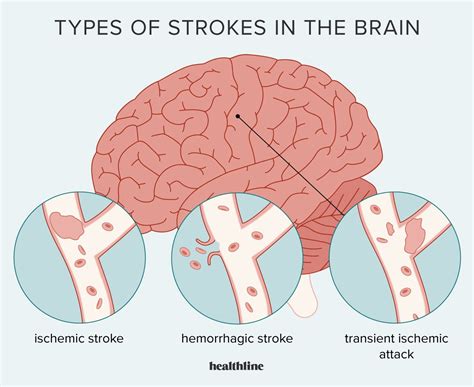 Stroke symptoms causes treatment types more – Artofit