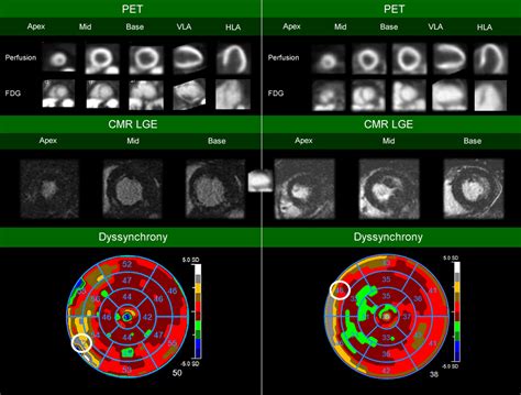 Performance of cardiac PET/CT with and without phase analysis for detection of scar in cardiac ...