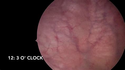 Image result for Videocystometrogram Procedure