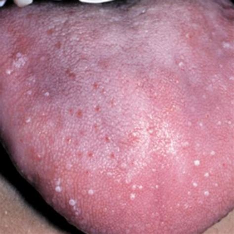 Chlamydia In The Tongue