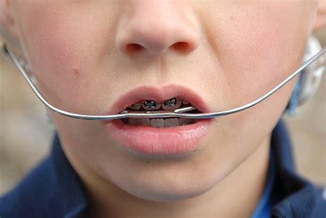 Mayo Functional Appliance in Gota - New Smile Dental Clinic
