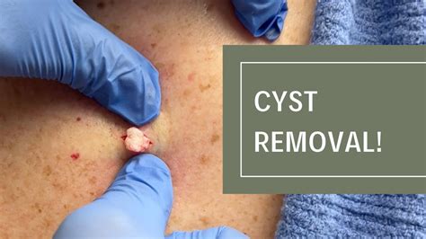 Image result for Cyst Extraction Videos