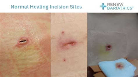 Incision Care after Bariatric Surgery | Photos | Healing & Recovery