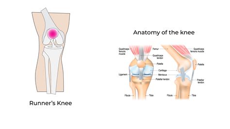 Runners Knee Exercises To Alleviate Pain | AKPC
