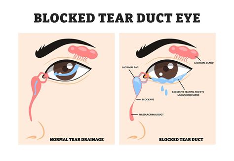 Blocked tear duct vs normal tear drainage, educational medical poster design healthcare scheme ...