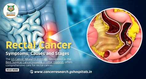 Rectal Cancer: Symptoms, Causes and Stages
