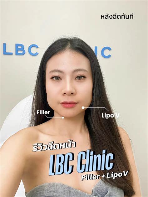 รีวิว Lipo V Size XXL + ฟิลเลอร์คาง ที่ LBC Clinic | แกลเลอรีที่โพสต์โดย Ravimookmai | Lemon8