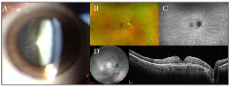 Primary Vitreoretinal Lymphoma: Current Diagnostic Laboratory Tests and New Emerging Molecular Tools