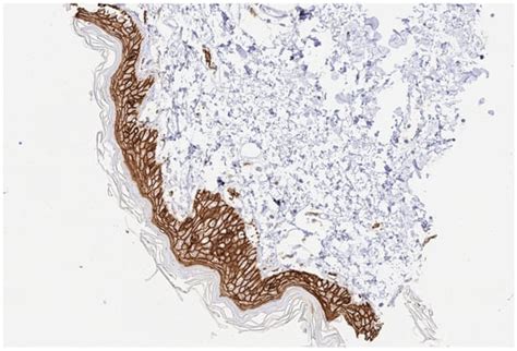 Trophoblast Cell Surface Antigen 2 (Trop2) Is Expressed in Cases of EBV ...