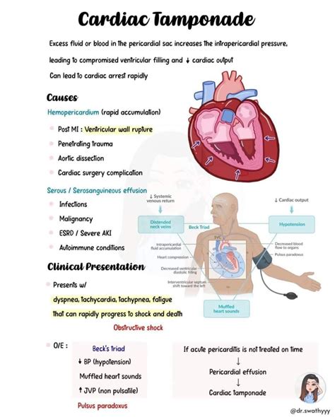 Pericardial tamponade what is it causes pericardial effusion signs ...