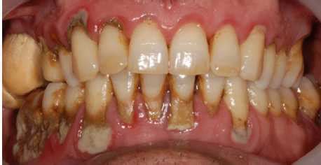 Image result for Bottom Teeth Calcium Buildup