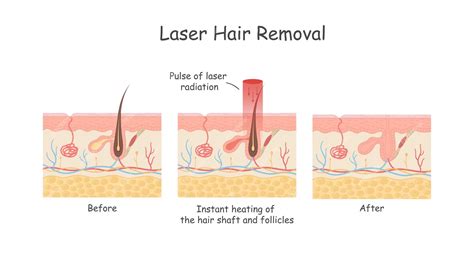 Premium Vector | Laser hair removal of the skin layer against hair Medical