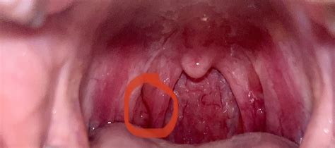 Lump on throat. Cancer? | Mumsnet