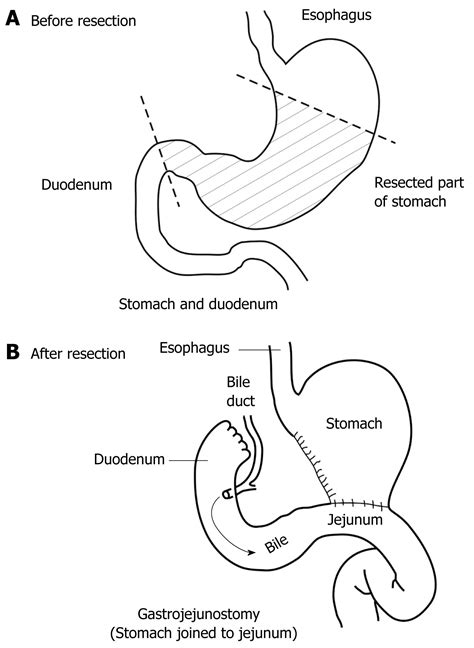 Billroth 2 Anatomy Choledochoduodenostomy Combined With Billroth II