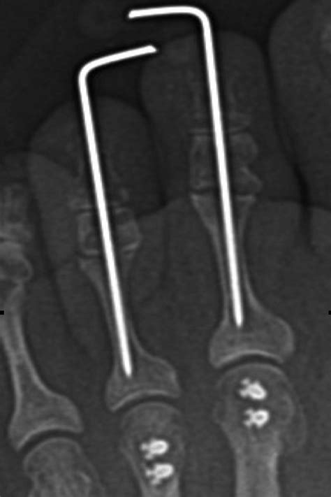 Image result for Toe Surgery