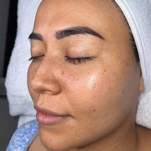 IPL Pigmentation Removal for Clear Skin | KR Skin Clinic