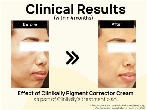 Buy Clinikally Pigment Corrector Cream Online at Best Price | Clinikally