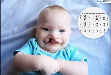 क्री दू शात सिंड्रोम से किस प्रकार की होती है परेशानी? - हैलो स्वास्थ्य