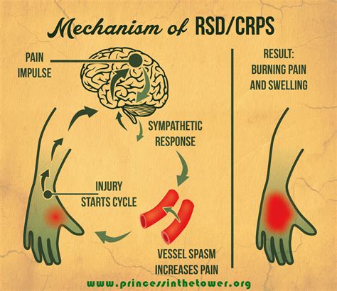 Treating Reflex Sympathetic Dystrophy (RSD) and CRPS - Synergy Physical ...