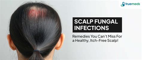 Scalp Fungal Infections: 10 Effective Home Remedies